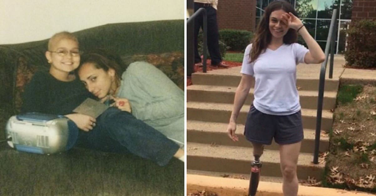 Aveva 11 anni  quando perse una gamba a causa del cancro, ma dopo 20 anni lei è un esempio per tanti.