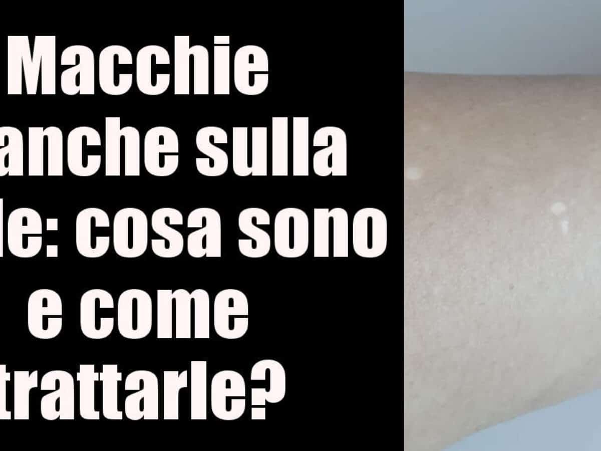 Macchie Bianche Sulla Pelle Cosa Sono E Come Trattarle