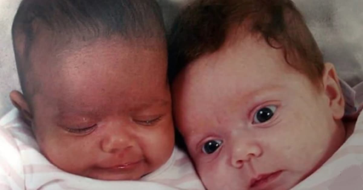 Le gemelle sembravano quasi identiche quando sono nate ma nel giro di pochi mesi, i genitori notarono alcuni cambiamenti.