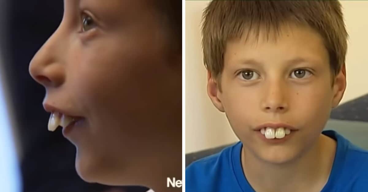Viene bullizzato per i suoi denti: ma grazie all’aiuto degli abitanti del suo paese, ha un nuovo sorriso