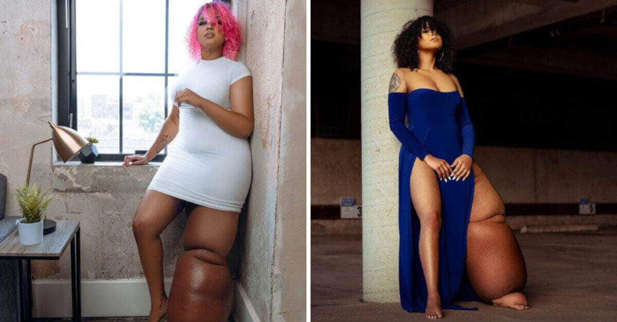 La donna aspira ad essere una modella nonostante abbia una gamba di 45 chili. Gli dicono che dovrebbe farla amputare