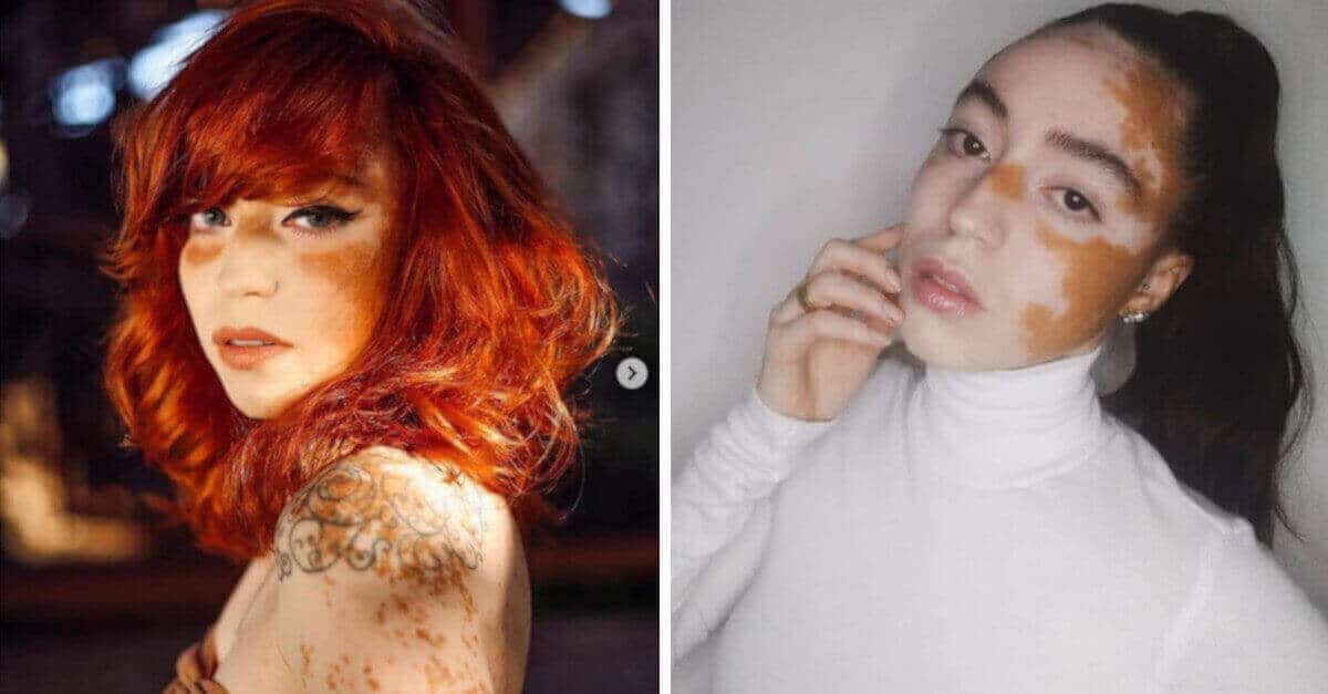 La donna con vitiligine supera i suoi problemi di fiducia dopo essere diventata una modella