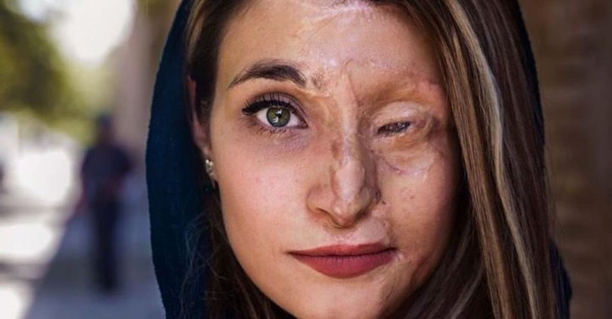 Degli uomini hanno aggredito con l’acido una donna iraniana per non aver indossato gli abiti tradizionali. Lei ha sorriso di nuovo