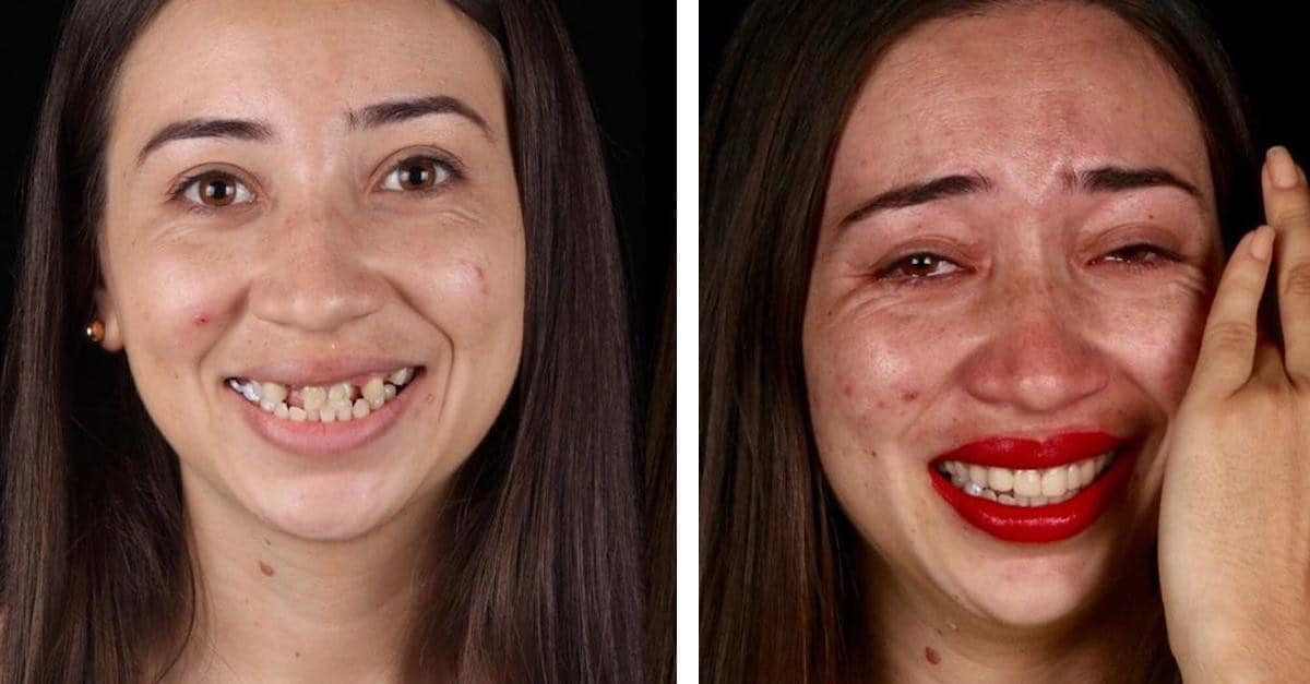 16 foto prima e dopo di persone con “denti nuovi”