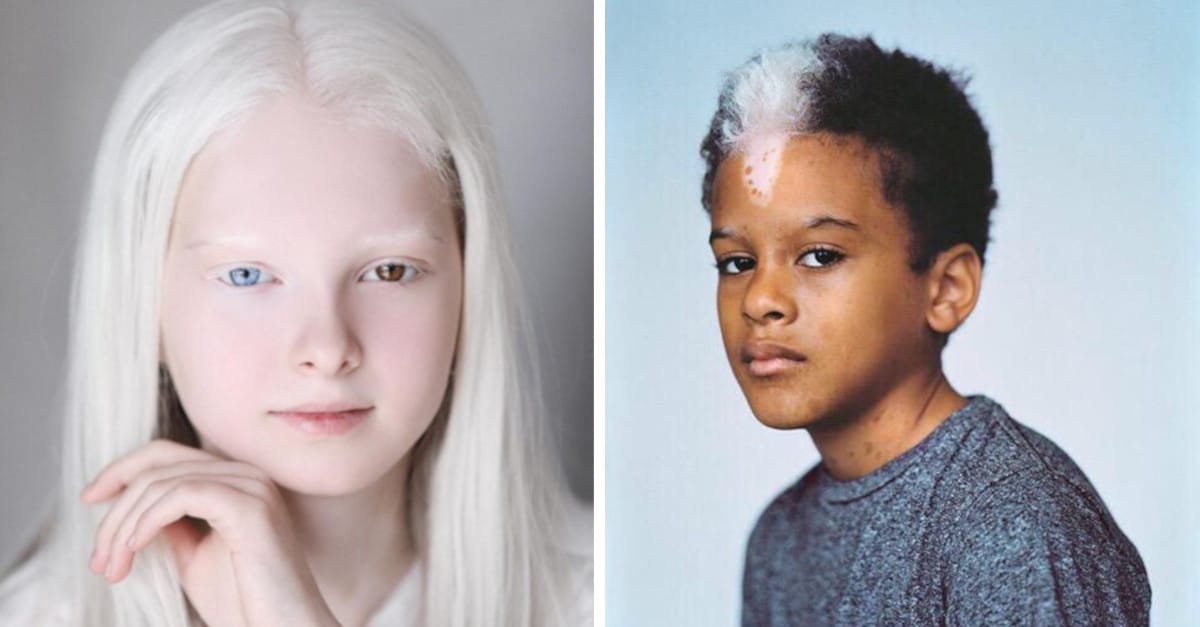 25 persone che la genetica ha reso uniche