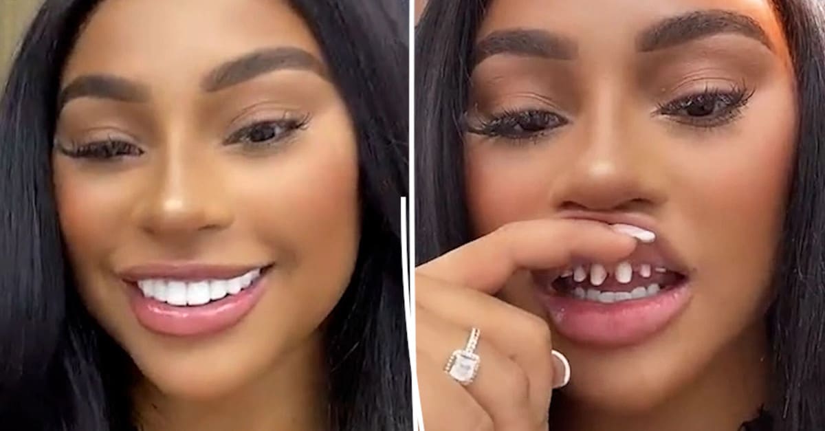 La nuova tendenza tra i giovani è quella dei denti limati, fa temere il peggio ai dentisti