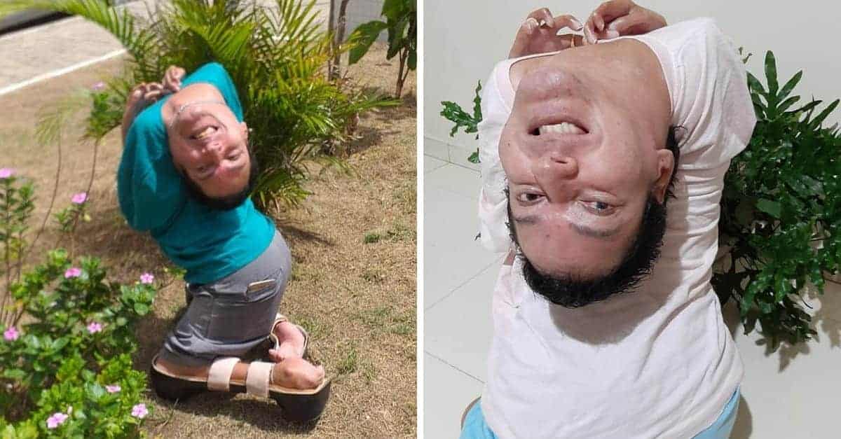 I medici avevano dichiarato che non avrebbe vissuto più di 24 ore, ma eccolo a 45 anni