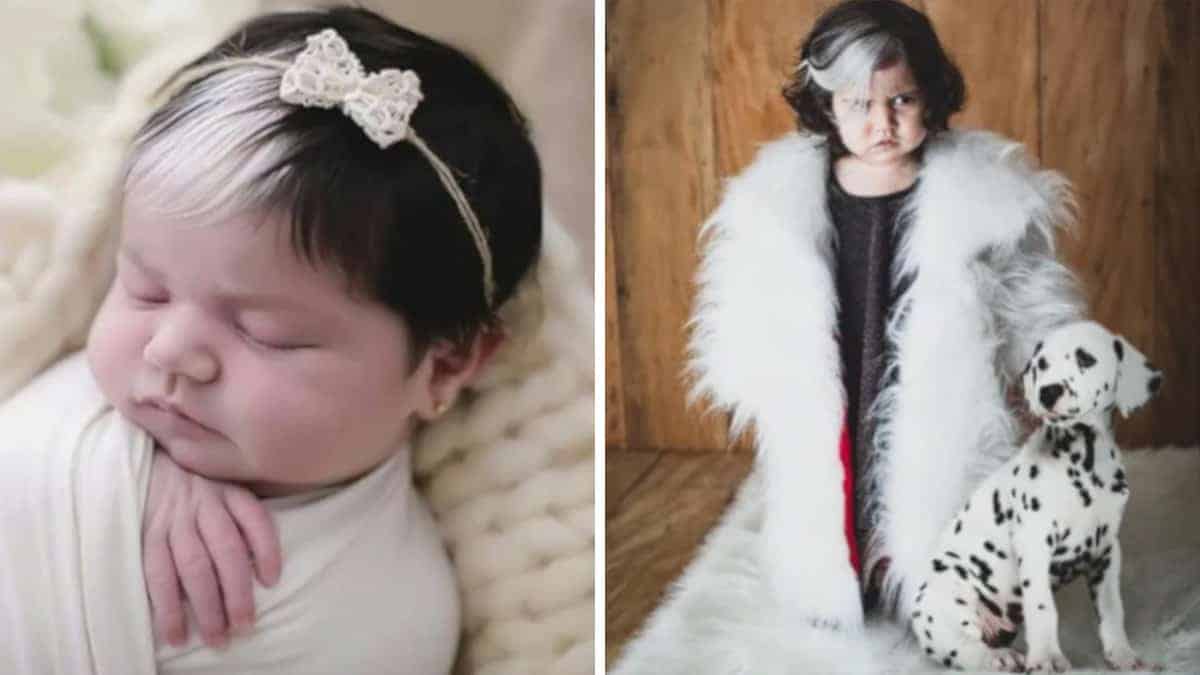 La bambina con un raro difetto genetico diventa una star di Instagram