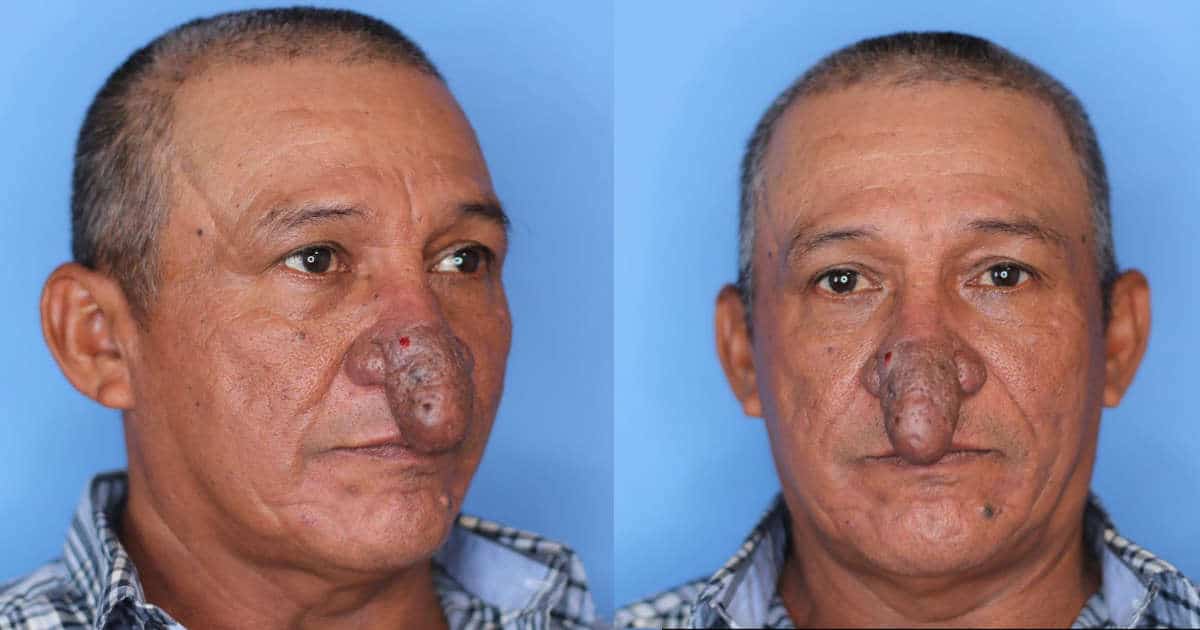 L’uomo soffre di una notevole malformazione al naso e scopre il suo nuovo naso per le vacanze di Natale