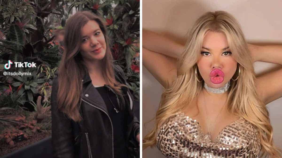 La famiglia le ha voltato le spalle per la chirurgia plastica: “Adoro le mie labbra enormi”
