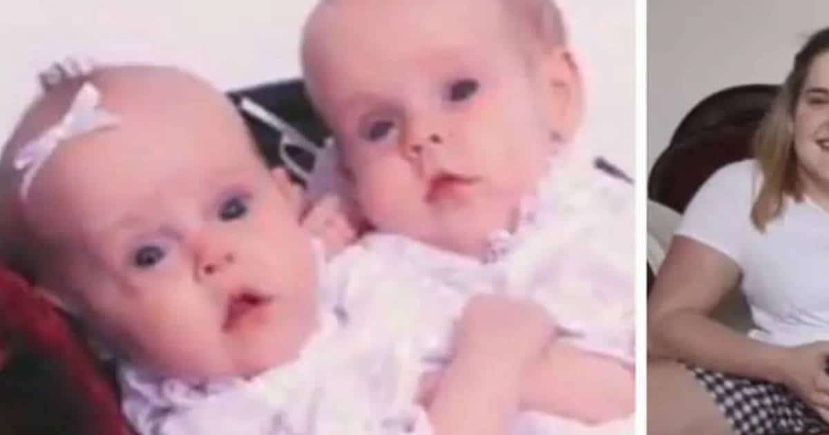 Chi sono Kendra e Maliyah Herrin, le gemelle siamesi che sono nate condividendo un fegato e un rene