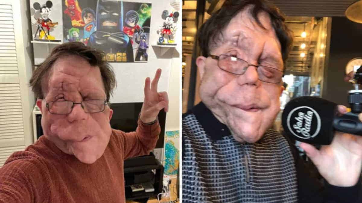 La storia di Adam Pearson, che non voleva passare la vita a soffrire e ha scelto di ispirare milioni di vite con il suo lavoro