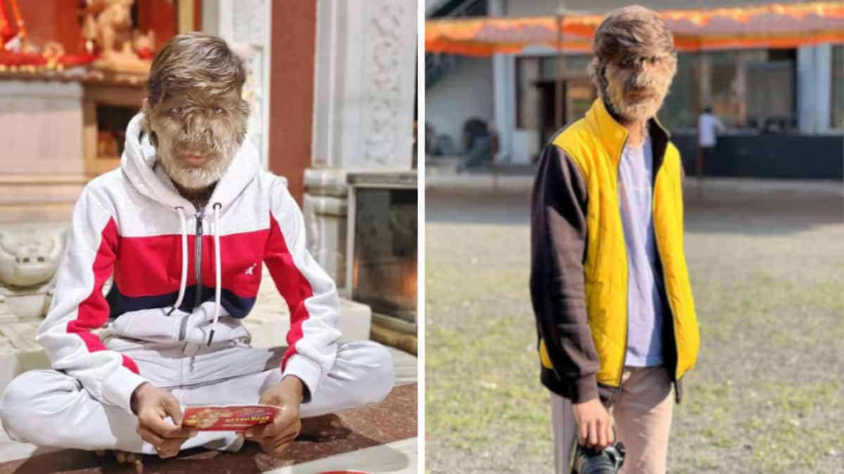 Giovane affetto dalla “sindrome del lupo mannaro” ha il viso totalmente coperto di peluria.