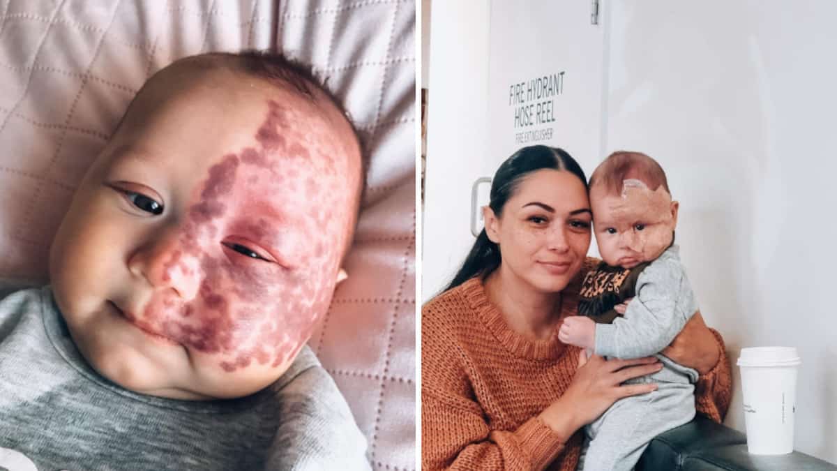 Riceve critiche per aver rimosso un neo dal viso del figlio con il laser: “Il motivo non è quello che pensate”
