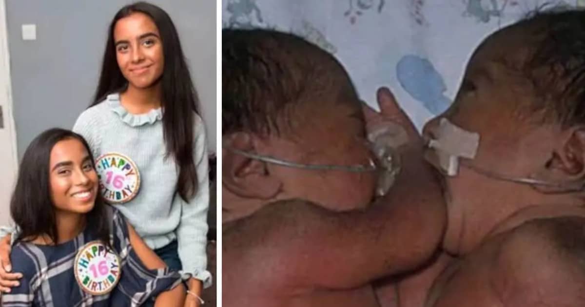 Non avevano nessuna possibilità: ma le gemelle siamesi separate sono cresciute e sono diventate delle affascinanti ragazze