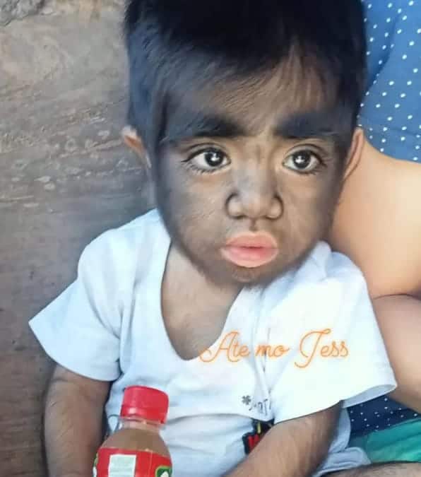 Jaren Gamongan: la storia del bambino più peloso al mondo